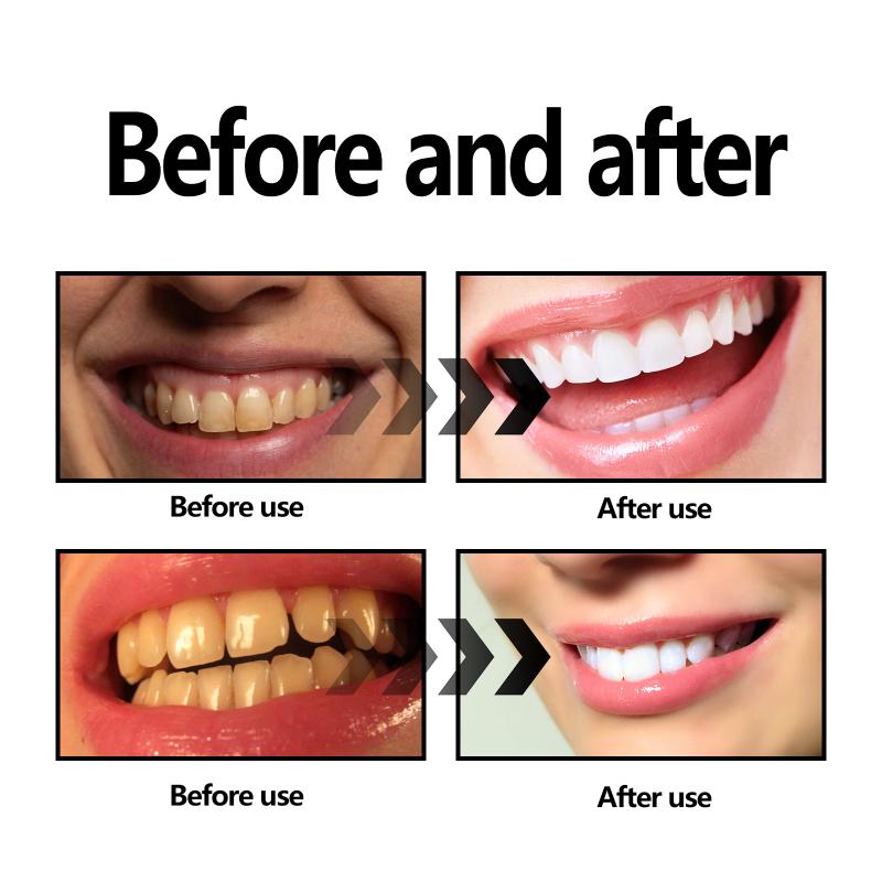 مسحوق تبييض الأسنان فحمي/صودا  - مراجعة Teeth Whitening With Baking Soda وسعره