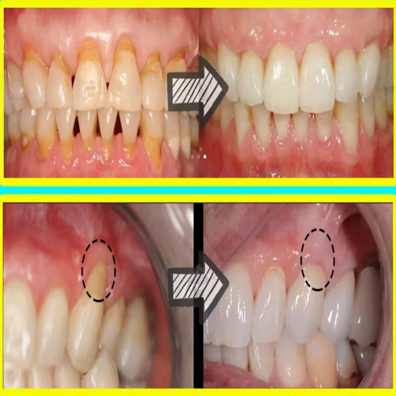 إصلاح سريع مصل اللثة تخفيف إعا - مراجعة Teeth Whitening With Baking Soda وسعره