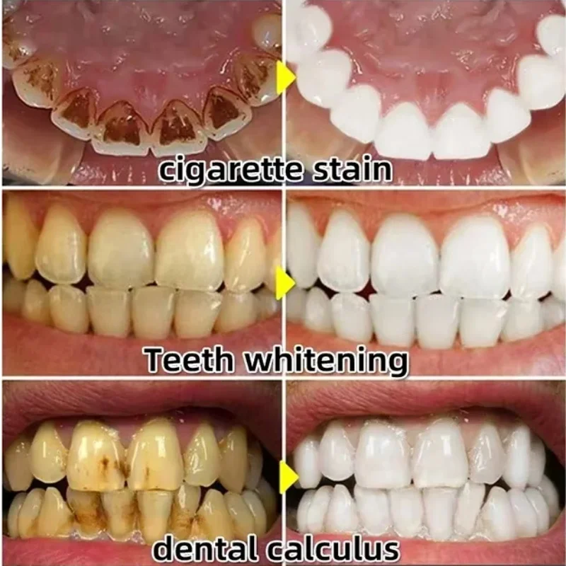 إصلاح سريع مصل اللثة تخفيف إعا - مراجعة Teeth Whitening With Baking Soda وسعره