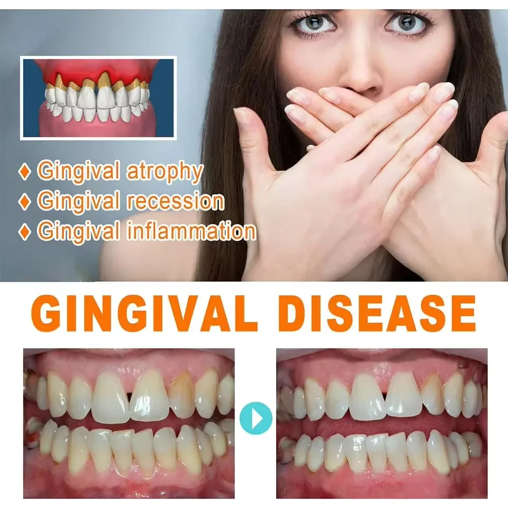 إصلاح سريع مصل اللثة تخفيف إعا - مراجعة Teeth Whitening With Baking Soda وسعره