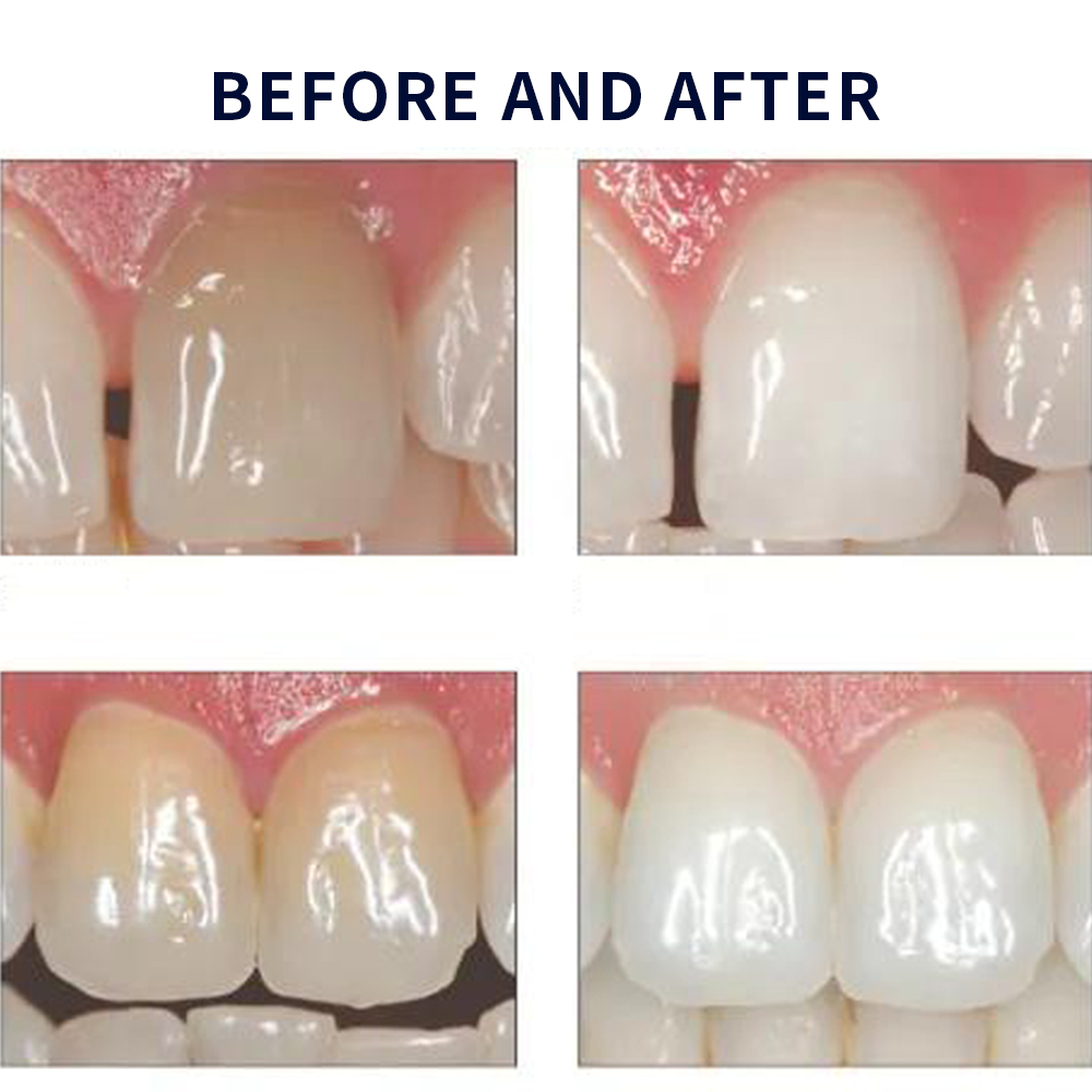 مجموعة جل تبييض أوباليزانس ، م - مراجعة Teeth Whitening Bleaching Kit وسعره