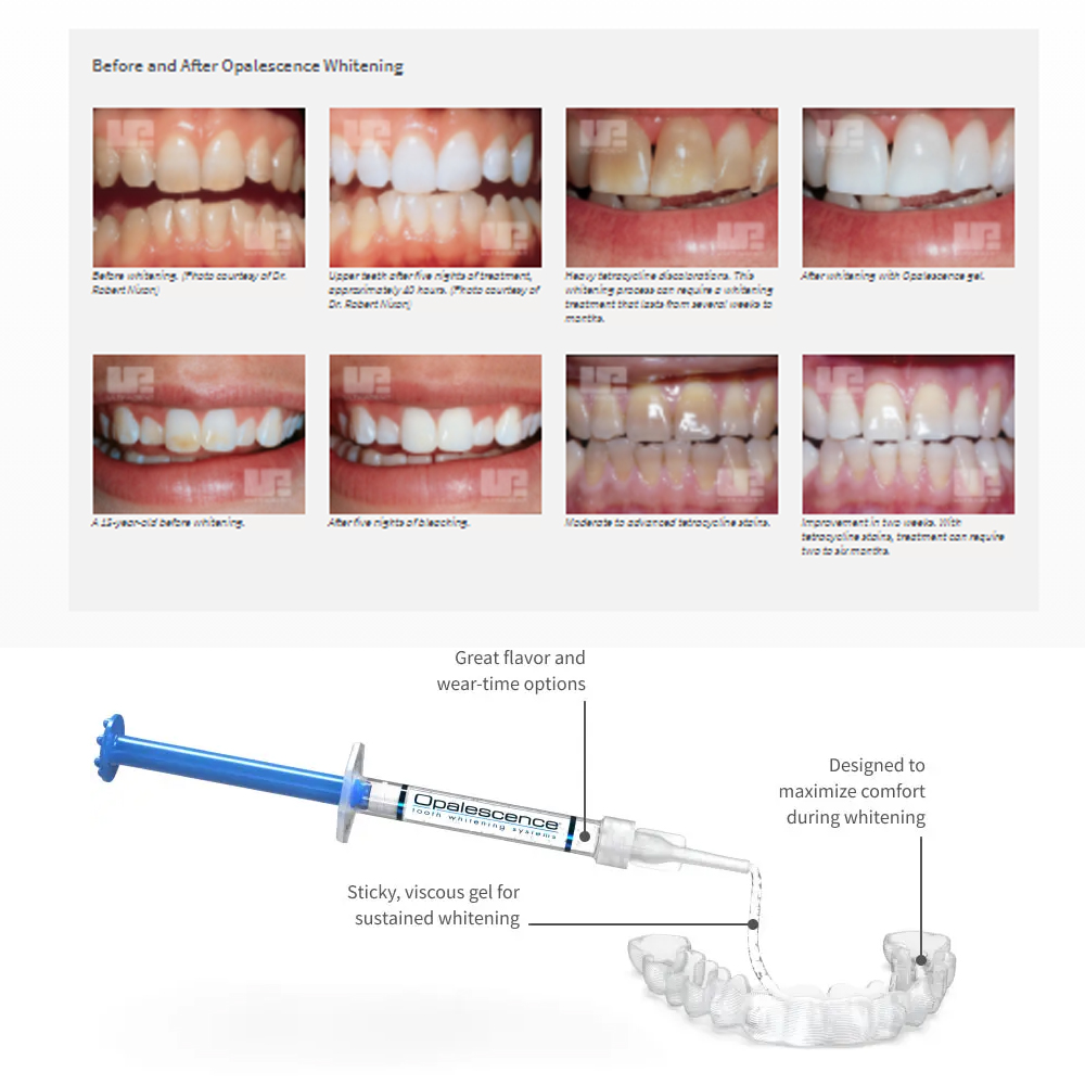 مجموعة جل تبييض أوباليزانس ، م - مراجعة Teeth Whitening Bleaching Kit وسعره
