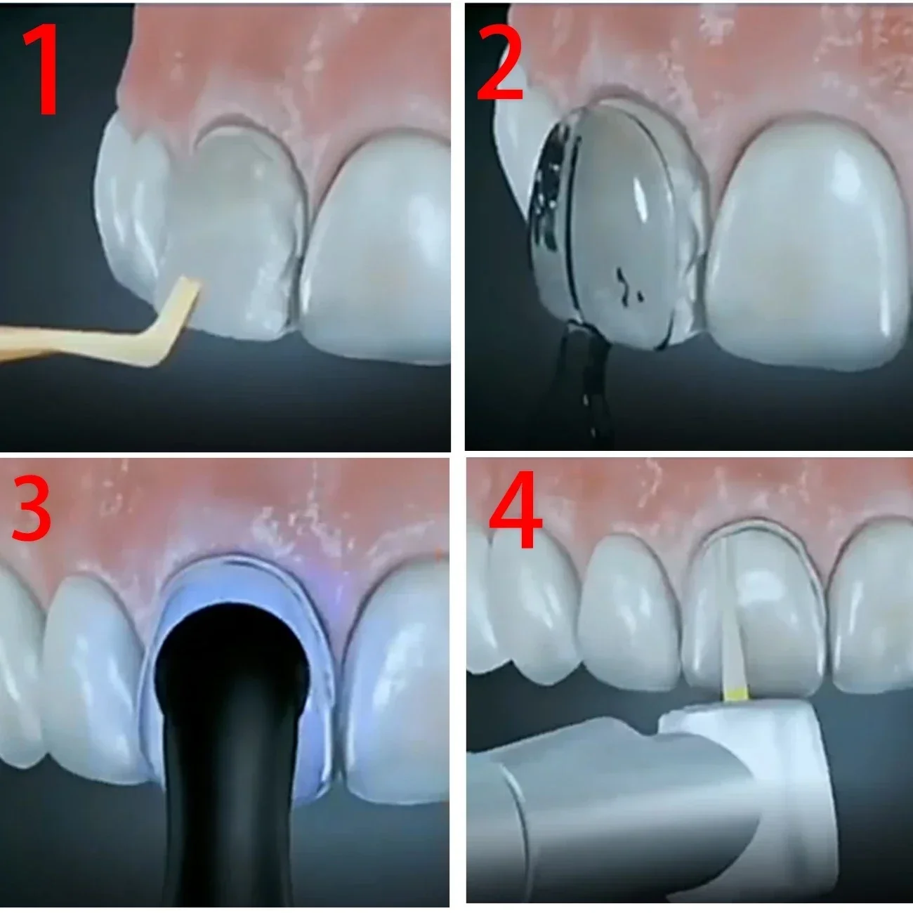 2 مجموعات مجموعة قوالب مختبر ا - مراجعة Teeth Whitening Moulds وسعره