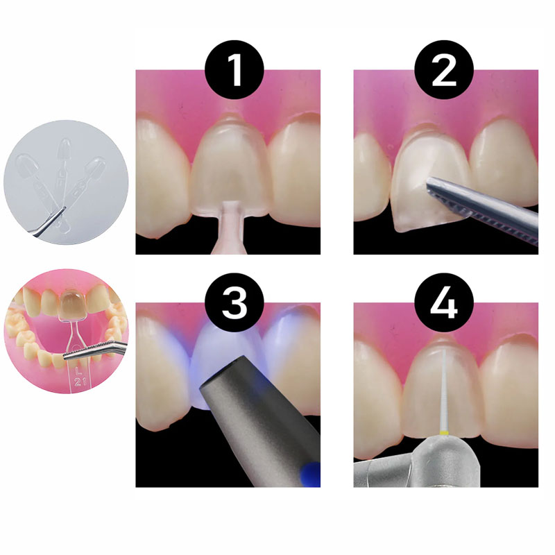 طقم قوالب أسنان من الراتنج الم - مراجعة Teeth Whitening Moulds وسعره