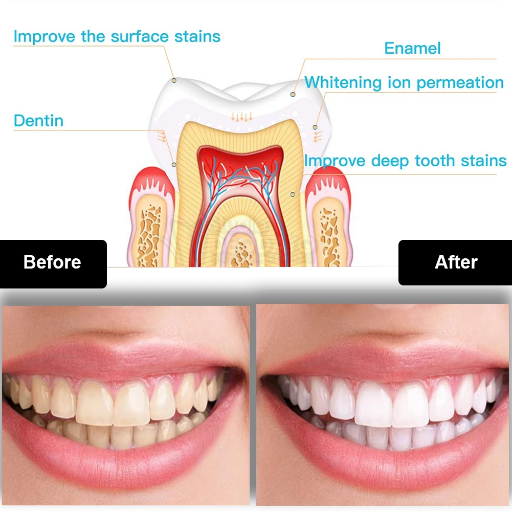 طقم تبييض الأسنان صغير 16 LED  - مراجعة Teeth Whitening Pens وسعره