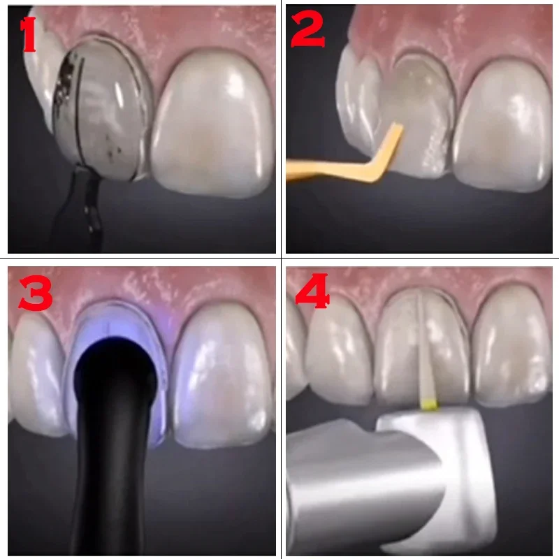 قوالب أسنان للاستخدام مع قشور  - مراجعة Teeth Whitening Moulds وسعره
