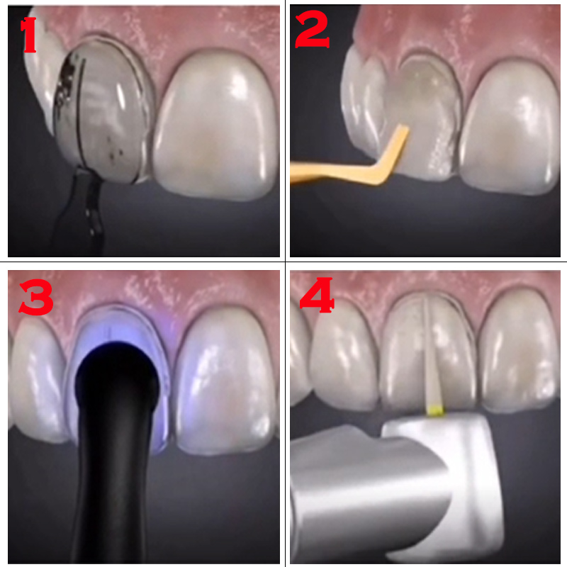 طقم قوالب أسنان 32 قطعة، قالب  - مراجعة Teeth Whitening Moulds وسعره