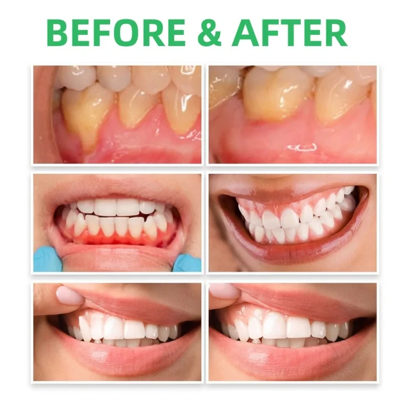 قطرات إصلاح اللثة تخفيف إعادة  - مراجعة Teeth Whitening Paste وسعره