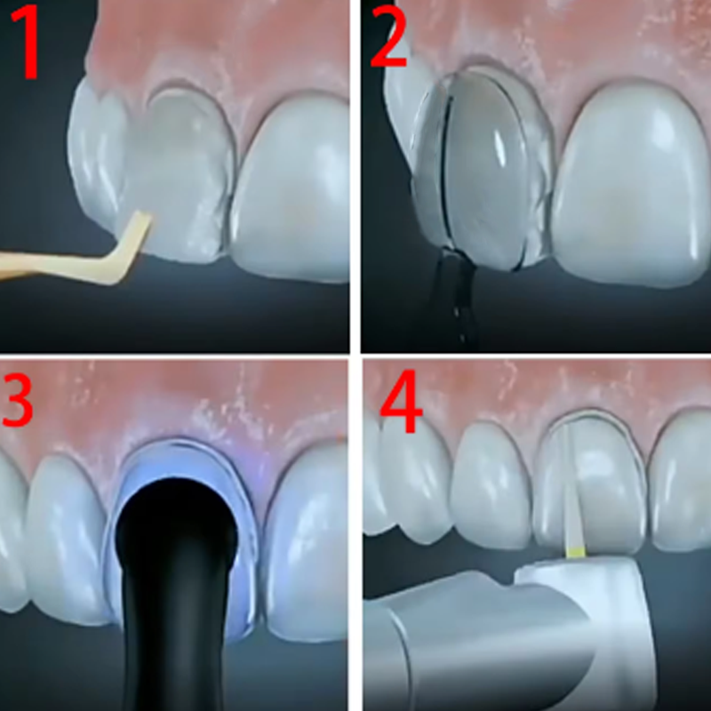 مجموعة قوالب قشرة الأسنان ، قا - مراجعة Teeth Whitening Moulds وسعره